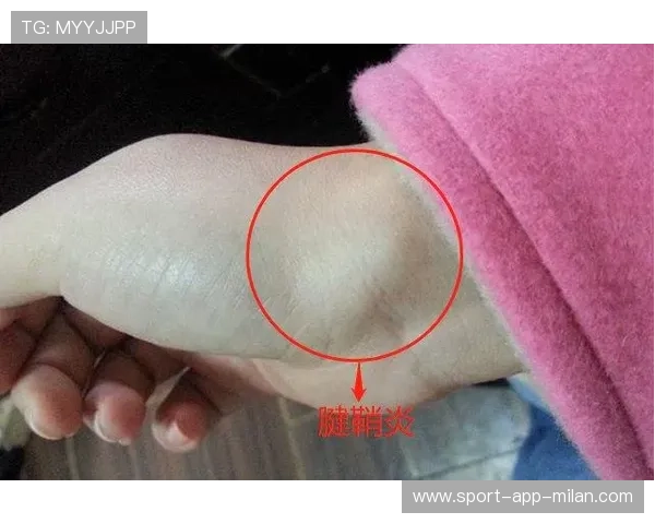 电竞选手的“腱鞘炎”：手腕劳损的职业病